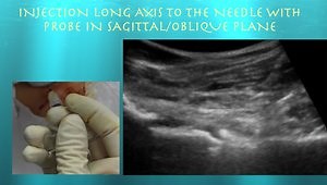 Hip Injections using Ultrasound Guidance