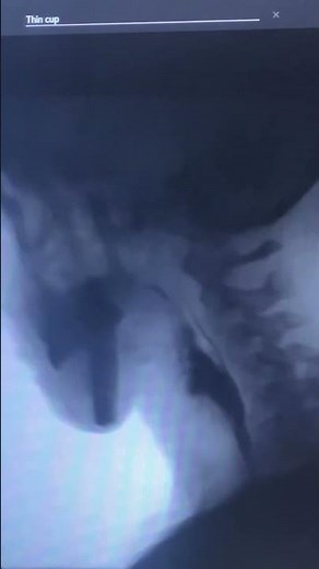 Modified Barium Swallow (MBS)