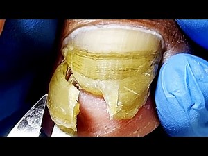 Complete Toenail Changes, Bad Nail Removal【Podiatry Clinic】