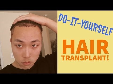 Do-It-Yourself (DIY) Hair Transplant Possible?