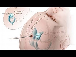EVD Insertion| External Ventricular Drain| Kocher’s Point| NEUROSURGERY| Dr Anil Kothiwala