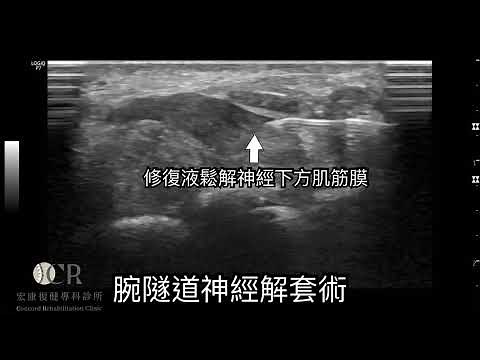 腕隧道症候群(正中神經解套術)