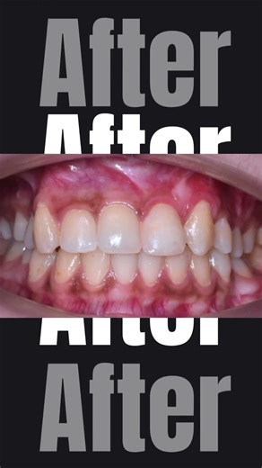 Composite Restoration | Natural & Seamless Tooth Repair ✨ #dentist #trending #trendingshorts