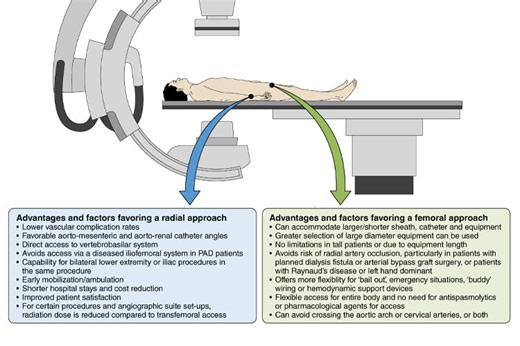 Radial Access Approach to Peripheral Vascular Interventions