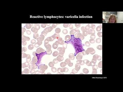 Lymphocytes Reactive vs Neoplastic