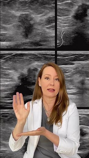 What Does Breast Cancer Look Like on an Ultrasound?