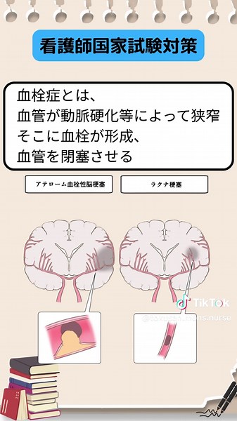 看護師国家試験 今回は脳梗塞の脳塞栓症について解説しました。 良ければフォロー・コメントよろしくお願いします。 ブログでも色々記事書いているので、プロフィールリンクから見てみてください！ #看護学生 #看護師 #看護師国家試験 #看護師国家試験対策 #脳梗塞