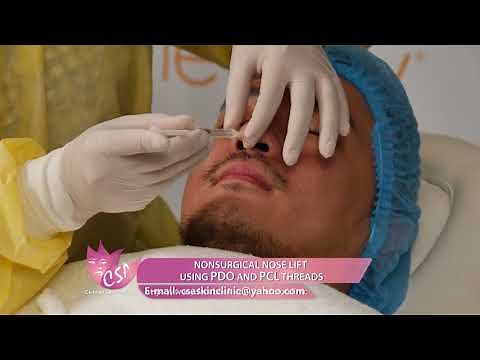 NONSURGICAL NOSE LIFT USING PDO AND PCL THREADS for men