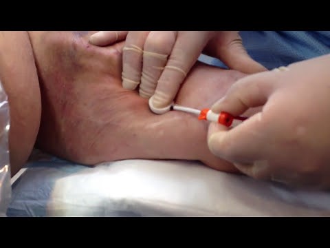 StatSeal Advanced Disc dialysis fistula sheath removal