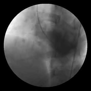 Ventricular Septal Defect seen on LV gram