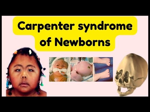 Birth Defects of Baby | Carpenter syndrome of Newborns | Tower head of Baby
