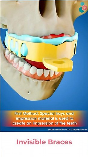 Invisible Braces Treatment ↪ 3D Medical Animations #InvisibleBraces #ClearAligners