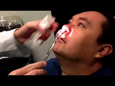 Doyle splint removal after sinus surgery