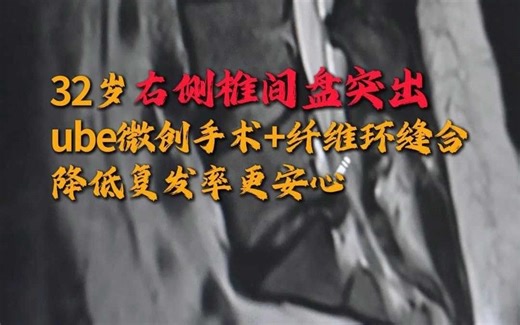 32岁右侧椎间盘突出 ube微创手术 纤维环缝合 降低复发率更安心