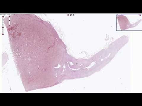 Pheochromocytoma - Histopathology