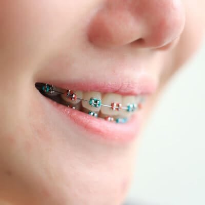 Moda en Colores de Brackets: Tendencias y Estilos Actuales [ 2024 ]