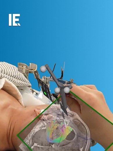 SurgicalAR provides real-time 3D holographic views of patient anatomy, enhancing precision in brain tumor removal while preserving crucial functions, revolutionizing neurosurgery with improved safety and efficacy. 📸: YouTube / @medivisinc.4509 #SurgicalAR#RealTime3D#HolographicViews