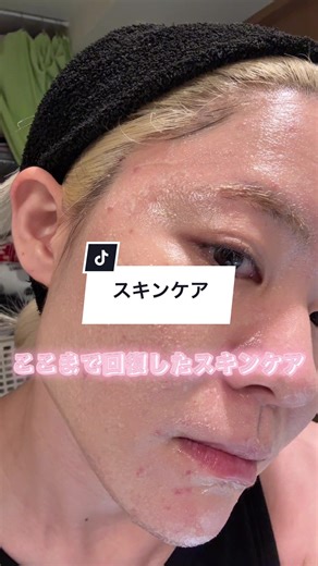 アスタリフトから商品いただきました！ 肌の調子絶不調だったので 2週間ほど使い続けてみたら めっちゃ肌回復！！ 使ってたスキンケアは変えてないんだけど めっちゃ回復して感動しております #スキンケア #アスタリフト #ニキビ