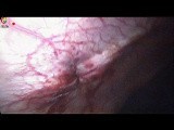 Nasr Fascial Closure Device for Multiple Suture for Large Port Site Size • Video • MEDtube.net