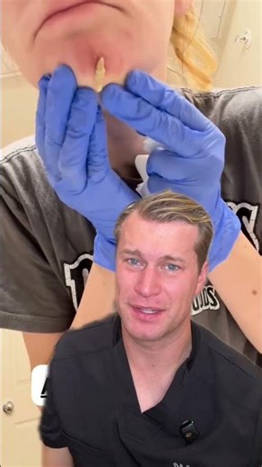 Poor girl has a massive facial cyst! #fyp #cyst #pimple #explosion #skin