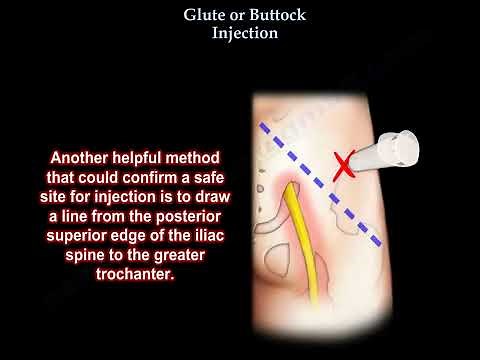 Safe Buttock Injection and Sciatic Nerve Considerations