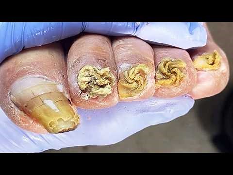 Advanced Pedicure: Complete Trimming of Unusually Long Toenails【Podiatry Clinic】
