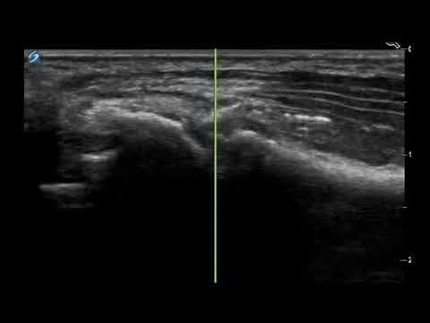 Wrist Ultrasound: Thumb CMC (Carpometacarpal ) Joint Injection (out of plane)
