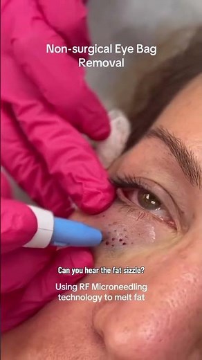 Non-Surgical Eye Bag Removal #shorts