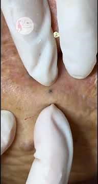 Squeeze the bean cyst | Nặn u bã đậu