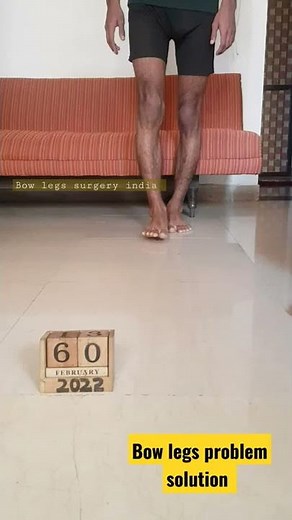 Ready for bow legs surgery india