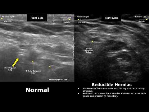 Inguinal Canal Ultrasound Normal Vs Hernia Imaging Findings | Direct & Indirect | Abdominal USG