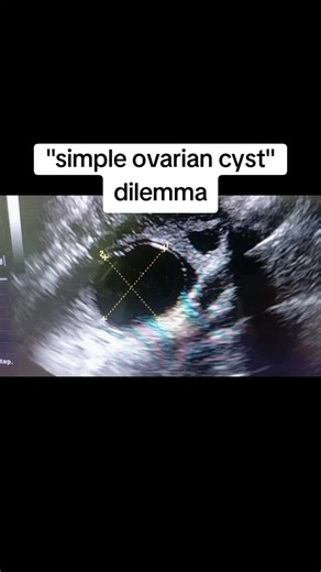 Understanding Ovarian Follicles in Ultrasound Scans