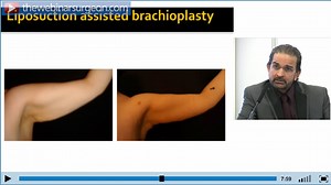 Liposuction - TheWebinarSurgeon