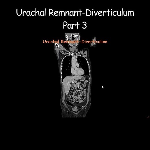 Urachal Remnant-Diverticulum Part 3 #radiology #radiologist #embryology #urinarybladder