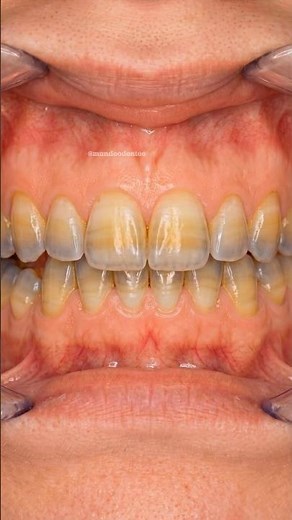 Why is Your Tooth Turning BLACK?! 💀🦷 #shorts #dentistry