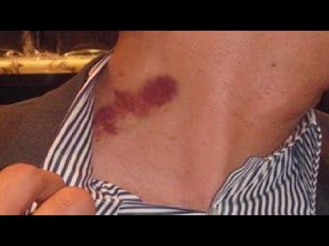 HOW TO GIVE A HICKEY FAST AND EASY
