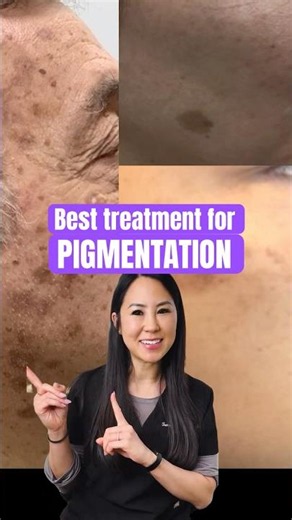 The Best Treatment for Pigmentation