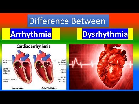 ARRHYTHMIA Vs. DYSRHYTHMIA