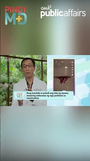Paano malalaman kung benign o malignant ang myoma? | Pinoy MD