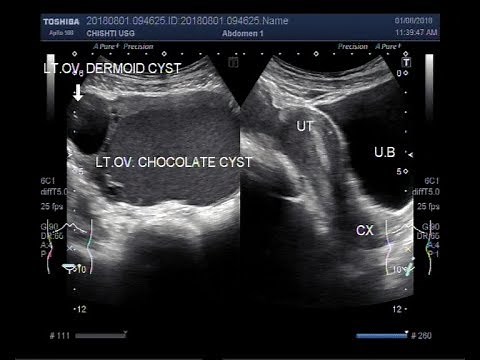 Ultrasound Video showing a large Chocolate ovarian cyst and a smaller Dermoid ovarian cyst.
