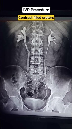 Contrast filled ureters #ivp #intravenouspylography