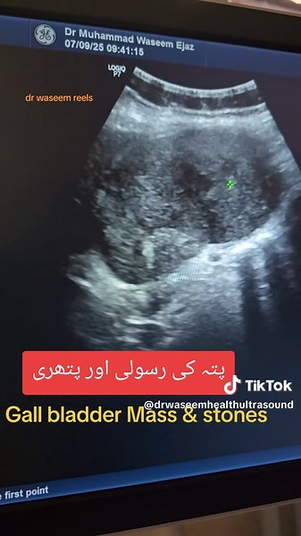 Understanding Gallbladder Mass and Stones