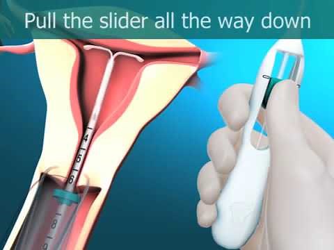 The new Mirena insertion & removal