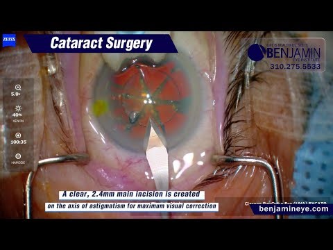 Cataract Surgery with OMNI MIGS