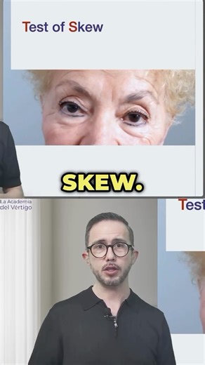 La Academia del Vértigo on Instagram: "🎯 ¿Qué es el Test of Skew y por qué importa? El tercer signo del protocolo HINTS es el skew, una mala alineación vertical de los ojos que puede pasar desapercibida… pero es clave para identificar lesiones centrales en pacientes con vértigo agudo. 👁️ A veces puede causar diplopía, otras veces el paciente la compensa, y por eso es fundamental buscarla activamente. 👉 La prueba es simple: tapamos un ojo y observamos el movimiento del que se destapa. Si hay c