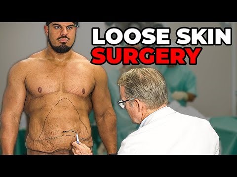Tummy Tuck Surgery (Pre-Op Drawings)