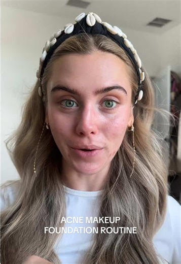 Ultimate Acne Makeup Routine for Glowy Skin