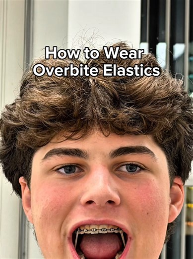 Let @emeric34 show you how to wear overbite elastics #fyp #braces #orthodontist #satisfying #dentistry