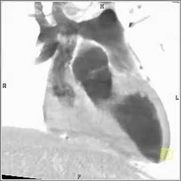4D Imaging of the Aortic Valve 3D and 4D rendering of the heart (3 of 3)