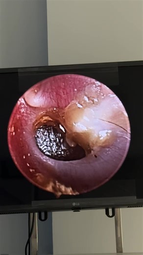 ក្រដាសត្រចៀកធ្លាយហើយ ដុះជិតវិញ😍 Telegram 089590007